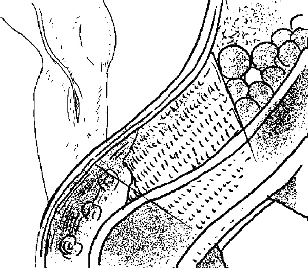 Иллюстрация к книге — Варикозное расширение вен. Лечение традиционными и нетрадиционными методами [_01.jpg]