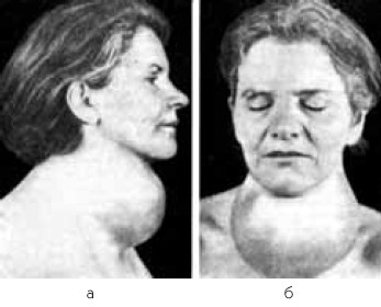 Иллюстрация к книге — Заболевания щитовидной железы. Лечение и профилактика [i_022.jpg]