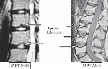 Иллюстрация к книге — Остеохондроз для профессионального пациента [i_066.jpg]