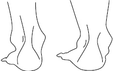 Иллюстрация к книге — Плоскостопие. Самые эффективные методы лечения [Autogen_eBook_id9.jpg]