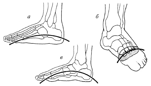 Иллюстрация к книге — Плоскостопие. Легкая походка - здоровый позвоночник [Autogen_eBook_id6.jpg]