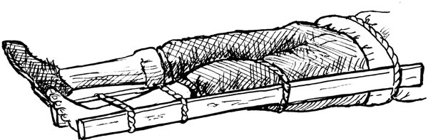 Иллюстрация к книге — Всегда готов! Курс выживания в экстремальных условиях для современных мужчин [_34splint.jpg]