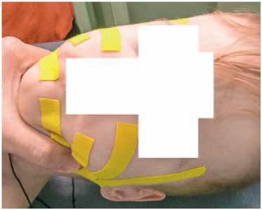 Иллюстрация к книге — Кинезиотейпинг в лечебной практике неврологии и ортопедии [i_020.jpg]