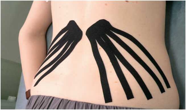 Иллюстрация к книге — Кинезиотейпинг в лечебной практике неврологии и ортопедии [i_038.jpg]