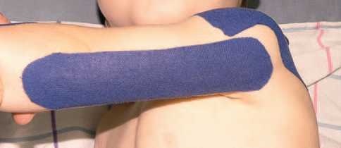 Иллюстрация к книге — Кинезиотейпинг в лечебной практике неврологии и ортопедии [i_063.jpg]