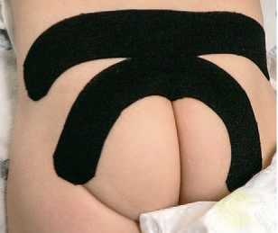 Иллюстрация к книге — Кинезиотейпинг в лечебной практике неврологии и ортопедии [i_134.jpg]