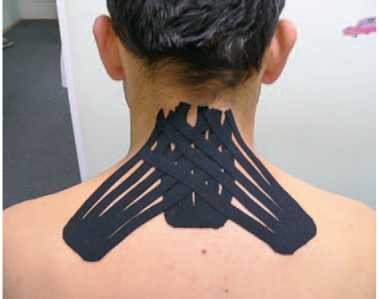 Иллюстрация к книге — Кинезиотейпинг в лечебной практике неврологии и ортопедии [i_145.jpg]