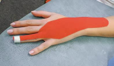 Иллюстрация к книге — Кинезиотейпинг в лечебной практике неврологии и ортопедии [i_156.jpg]