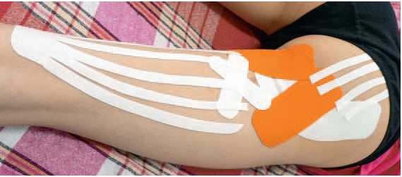 Иллюстрация к книге — Кинезиотейпинг в лечебной практике неврологии и ортопедии [i_185.jpg]