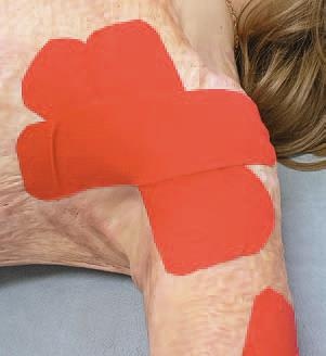 Иллюстрация к книге — Кинезиотейпинг в лечебной практике неврологии и ортопедии [i_216.jpg]