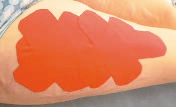 Иллюстрация к книге — Кинезиотейпинг в лечебной практике неврологии и ортопедии [i_224.jpg]