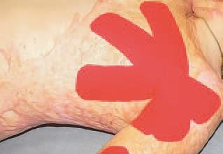 Иллюстрация к книге — Кинезиотейпинг в лечебной практике неврологии и ортопедии [i_230.jpg]