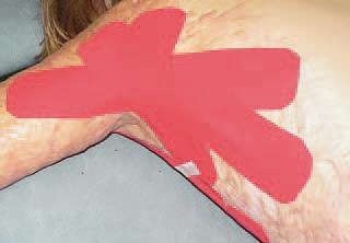 Иллюстрация к книге — Кинезиотейпинг в лечебной практике неврологии и ортопедии [i_231.jpg]