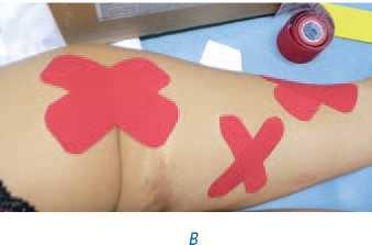 Иллюстрация к книге — Кинезиотейпинг в лечебной практике неврологии и ортопедии [i_254.jpg]