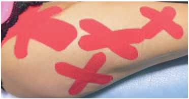 Иллюстрация к книге — Кинезиотейпинг в лечебной практике неврологии и ортопедии [i_255.jpg]