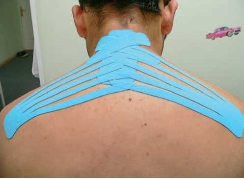 Иллюстрация к книге — Кинезиотейпинг в лечебной практике неврологии и ортопедии [i_257.jpg]