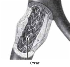 Иллюстрация к книге — Заболевания сердца и сосудов. Профилактика и лечение [i_031.jpg]