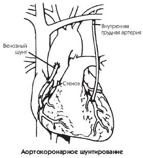 Иллюстрация к книге — Заболевания сердца и сосудов. Профилактика и лечение [i_032.jpg]