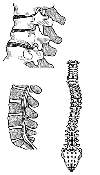 Иллюстрация к книге — Жизнь без боли в спине. Лечение сколиоза, остеопороза, остеохондроза, межпозвонковой грыжи без операции [i_055.jpg]