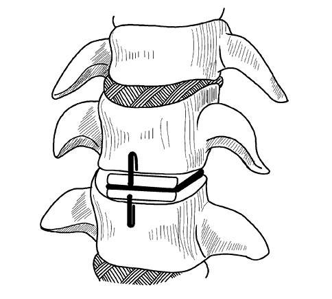 Иллюстрация к книге — Жизнь без боли в спине. Лечение сколиоза, остеопороза, остеохондроза, межпозвонковой грыжи без операции [i_074.jpg]