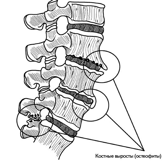 Иллюстрация к книге — Жизнь без боли в спине. Лечение сколиоза, остеопороза, остеохондроза, межпозвонковой грыжи без операции [i_113.jpg]