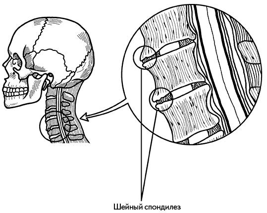Иллюстрация к книге — Жизнь без боли в спине. Лечение сколиоза, остеопороза, остеохондроза, межпозвонковой грыжи без операции [i_114.jpg]