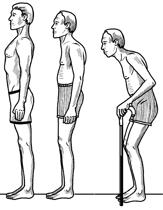 Иллюстрация к книге — Жизнь без боли в спине. Лечение сколиоза, остеопороза, остеохондроза, межпозвонковой грыжи без операции [i_124.jpg]