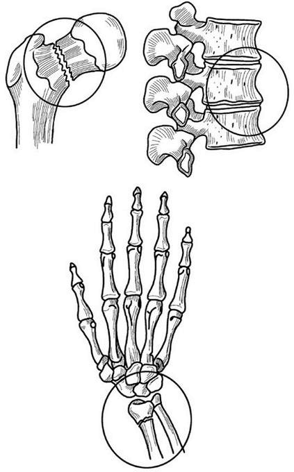Иллюстрация к книге — Жизнь без боли в спине. Лечение сколиоза, остеопороза, остеохондроза, межпозвонковой грыжи без операции [i_135.jpg]