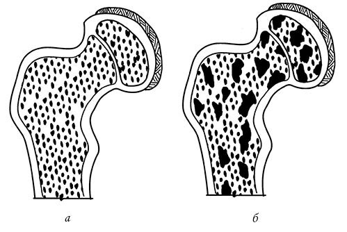 Иллюстрация к книге — Жизнь без боли в спине. Лечение сколиоза, остеопороза, остеохондроза, межпозвонковой грыжи без операции [i_136.jpg]