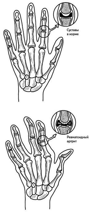 Иллюстрация к книге — Жизнь без боли в спине. Лечение сколиоза, остеопороза, остеохондроза, межпозвонковой грыжи без операции [i_162.jpg]