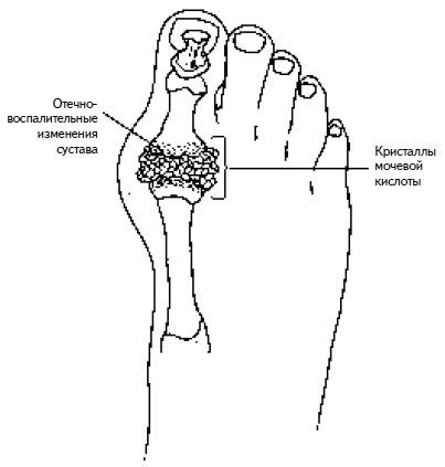 Иллюстрация к книге — Жизнь без боли в спине. Лечение сколиоза, остеопороза, остеохондроза, межпозвонковой грыжи без операции [i_165.jpg]