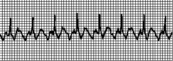 Иллюстрация к книге — Стоп-инфаркт. Как читать ЭКГ и заботиться о сердце [autogen_ebook_id10.jpg]