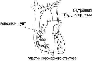 Иллюстрация к книге — Стоп-инфаркт. Как читать ЭКГ и заботиться о сердце [autogen_ebook_id27.jpg]