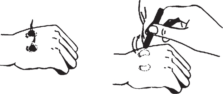 Иллюстрация к книге — Суджок - исцеляющий самомассаж. Основные приемы [autogen_ebook_id47.jpg]