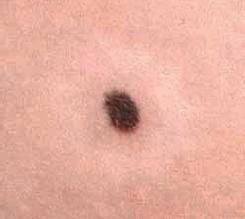 Иллюстрация к книге — Опасные родинки [autogen_ebook_id123.jpg]