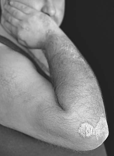 Иллюстрация к книге — Псориаз. Диета, лечение, профилактика [i_001.jpg]