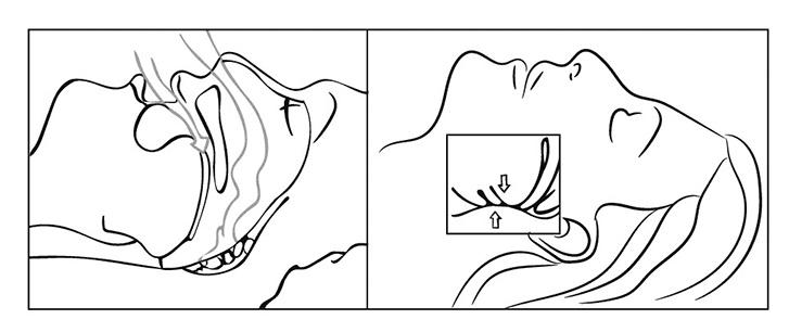 Иллюстрация к книге — Инсульт. До и после [i_043.jpg]