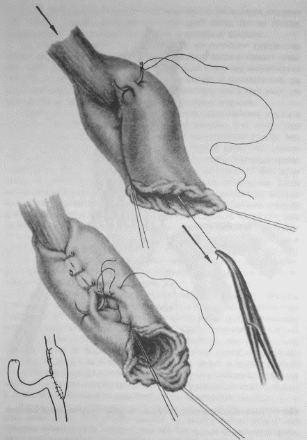 Иллюстрация к книге — Этюды желудочной хирургии [i_030.jpg]