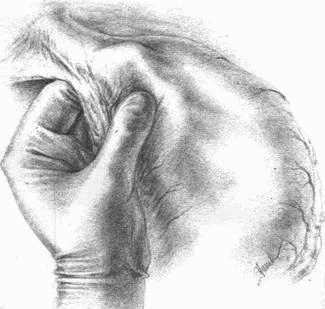 Иллюстрация к книге — Этюды желудочной хирургии [i_032.jpg]