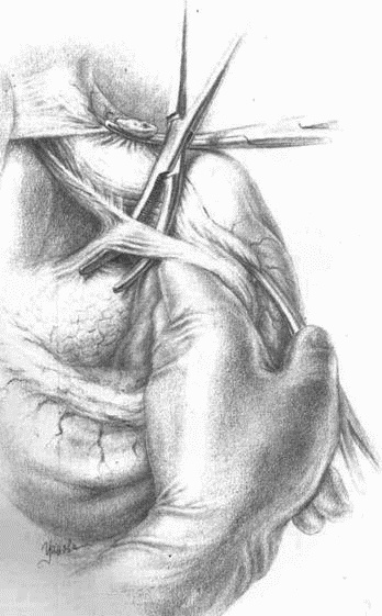 Иллюстрация к книге — Этюды желудочной хирургии [i_037.jpg]