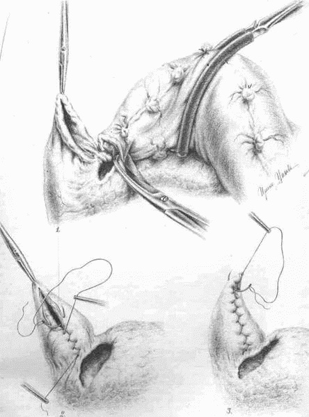 Иллюстрация к книге — Этюды желудочной хирургии [i_044.jpg]