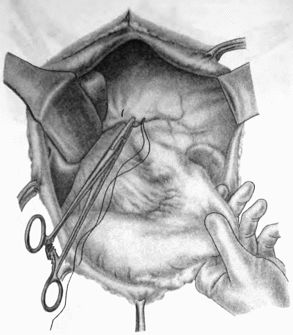 Иллюстрация к книге — Этюды желудочной хирургии [i_099.jpg]