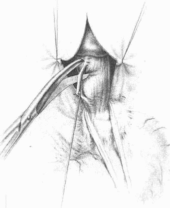Иллюстрация к книге — Этюды желудочной хирургии [i_103.jpg]