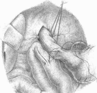 Иллюстрация к книге — Этюды желудочной хирургии [i_106.jpg]