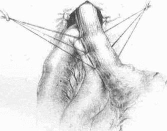 Иллюстрация к книге — Этюды желудочной хирургии [i_107.jpg]