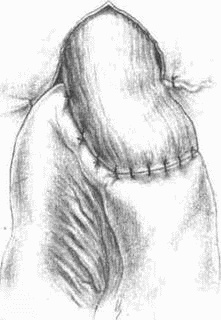 Иллюстрация к книге — Этюды желудочной хирургии [i_113.jpg]