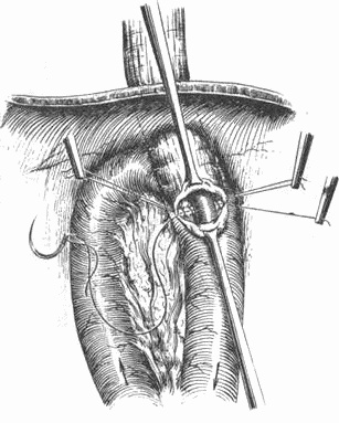 Иллюстрация к книге — Этюды желудочной хирургии [i_115.jpg]