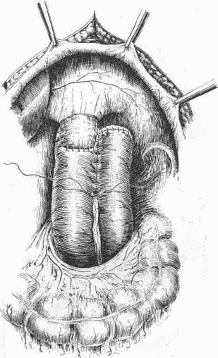 Иллюстрация к книге — Этюды желудочной хирургии [i_118.jpg]