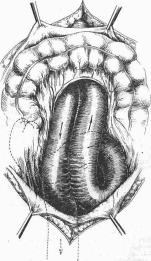 Иллюстрация к книге — Этюды желудочной хирургии [i_120.jpg]