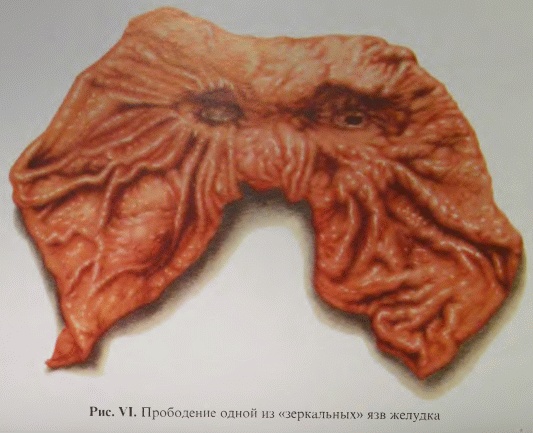 Иллюстрация к книге — Этюды желудочной хирургии [i_134.jpg]